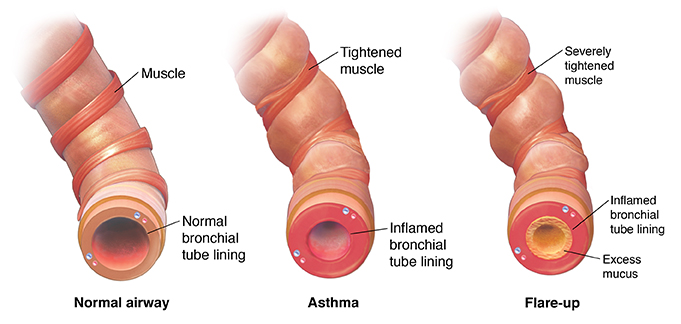 Bronquíolo normal, un estrechamiento del bronquíolo con asma y bronquíolo inflamado con exceso de mucosidad durante una crisis de asma.